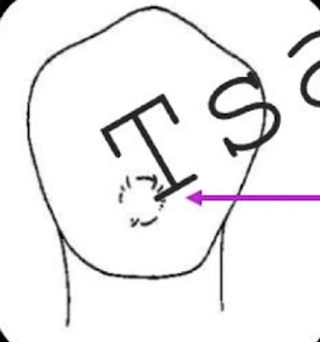 <p>What bur is used to make a retentive groove preparation for the dimple of the I-bar?</p>