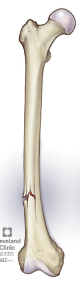 <p><strong>Incomplete break: </strong>One side cracks, the other side bends</p>