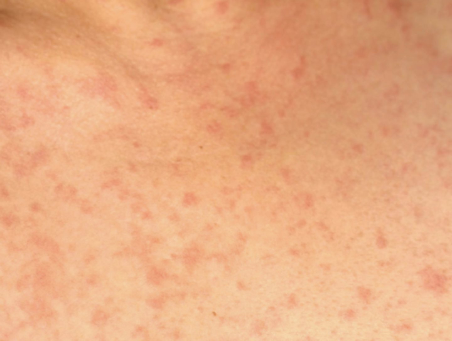 <p>Acute or chronic GVHD?</p>