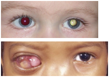<ul><li><p><span style="background-color: transparent;">If you let retinoblastoma go untreated it can grow a tumor and you can notice it has vasculature (red)...for it to grow so large it need blood vessels to deliver stuff to it … thought process → most cancer treatments target the tumor but the problem with this is tumour growth is different in everyone so MAYBE if we can target the tumors blood supply it wouldn’t be allowed to grow any more because you're also then targeting the tumour nutrients and oxygen with it (could be a protein cancer treatment)...might be able to shrink it…die with it but not die from it&nbsp;</span></p></li></ul><p></p>