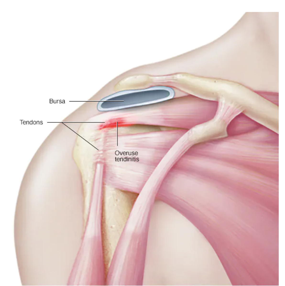 <p>Tendinitis (tendin-)</p>