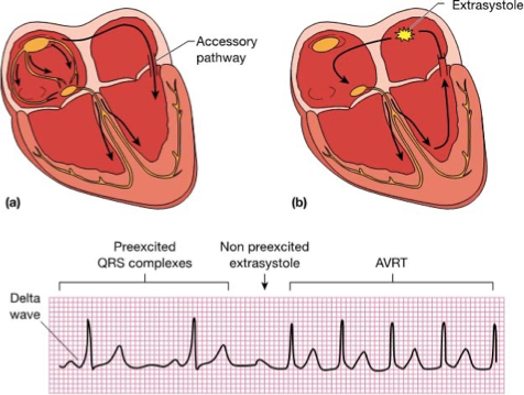 <p>What does this refer</p><ul><li><p>Accessory pathway between atria and ventricles can bypass AV node completely, setting up large reentrant circuit</p></li><li><p>Without extrasystole, impulse moves anterograde between atria and ventricles—creating delta wave (early rise of QRS complex)</p></li><li><p>With ectopic beat, circus rhythm creates tachycardia</p></li></ul><p></p>