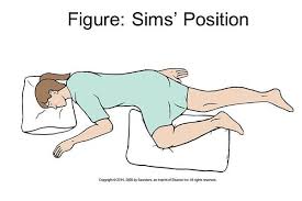 <p>A variation of the lateral position where the person lies on their left side, with the right knee bent and drawn up towards the chest. </p>