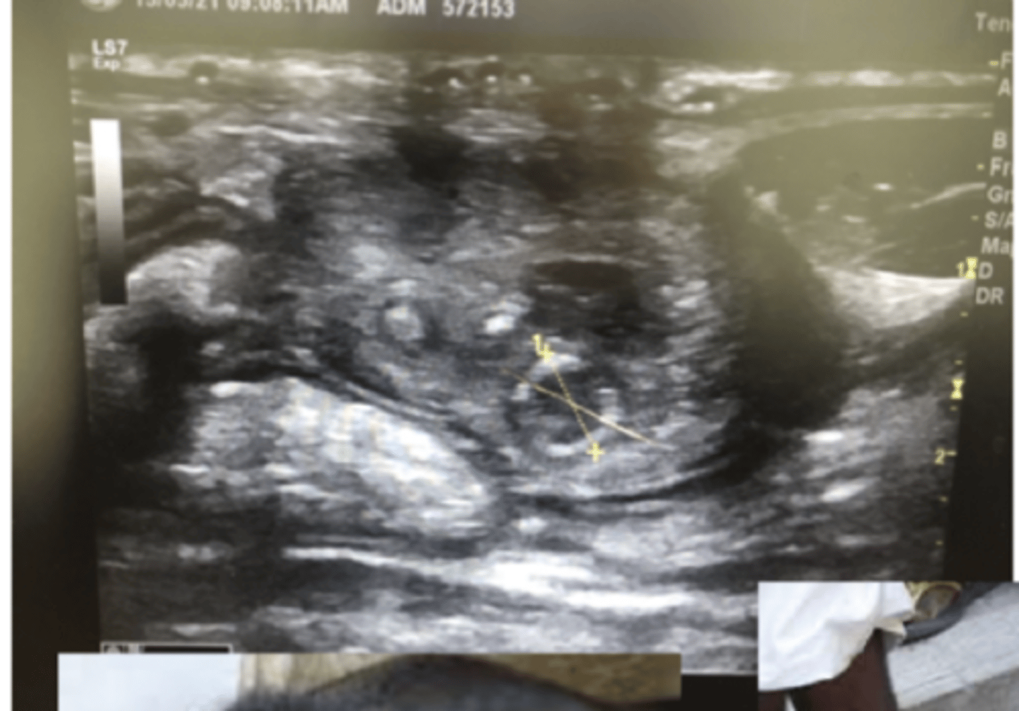 <p>outcomes of failure of passive transfer of immunity 1</p>