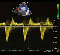 <p>What is seen in this image?</p><p>Where is it located?</p><p>What condition is it seen in?</p>