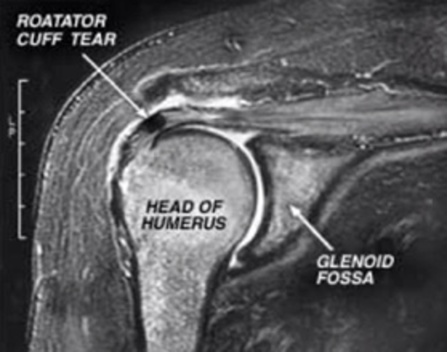 <p>XRAY </p><p>MRI (gold standard)</p><p>Ultrasound</p>