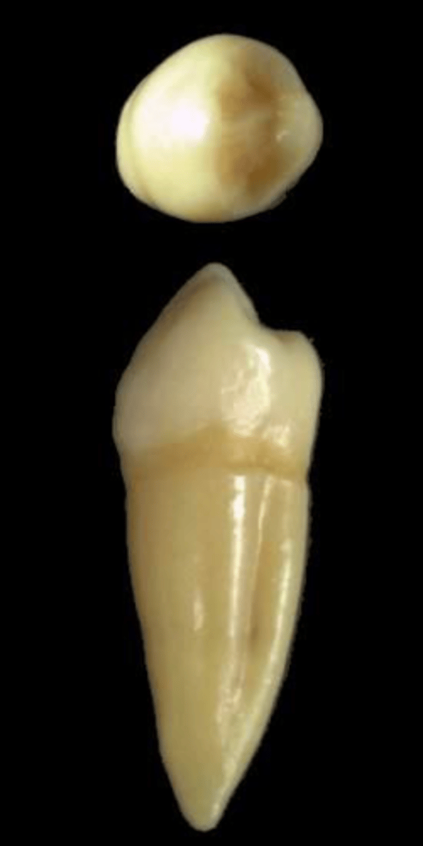 <p>what tooth is this &amp; why?</p>