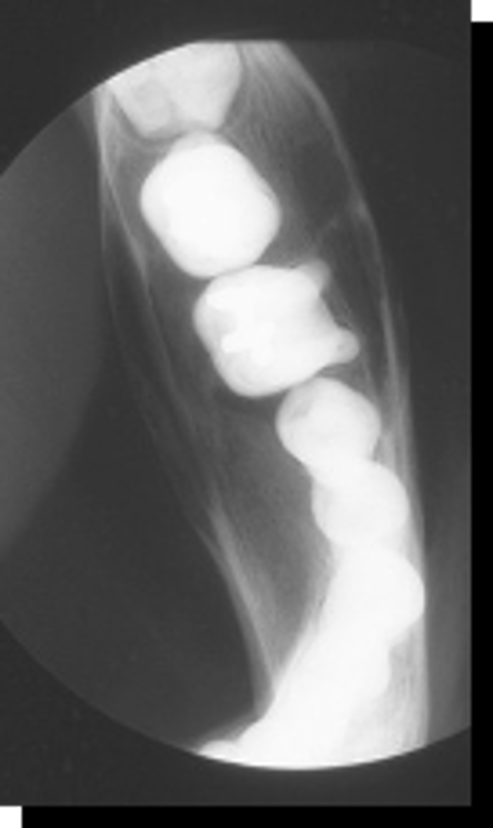 <p>benign tumors have what affect on cortical bone surrounding structures?</p>