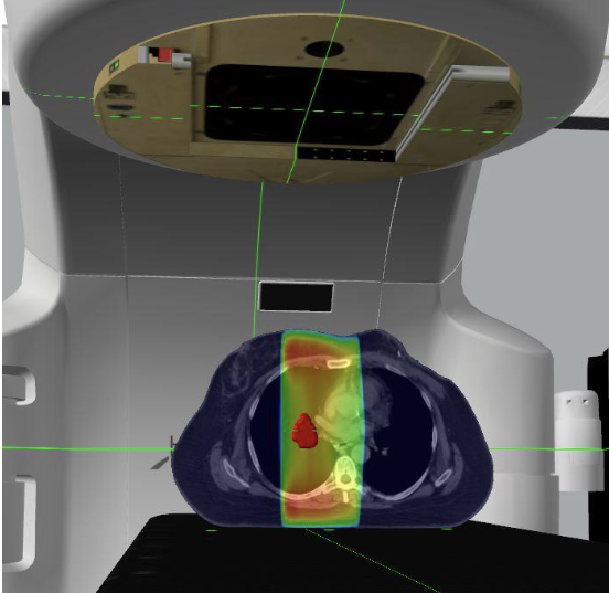 <p>Describe this treatment technique</p>
