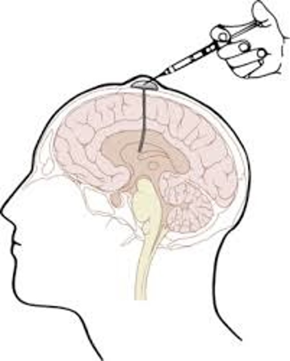 <p>a device used to deliver chemotherapy directly into the cerebrospinal fluid (CSF) around the brain and spinal cord. It allows chemotherapy to reach areas of the central nervous system (CNS) that might otherwise be difficult to treat due to the blood-brain barrier</p>