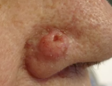 <p>Noduloulcerative- slightly elevated and central ulcer</p>