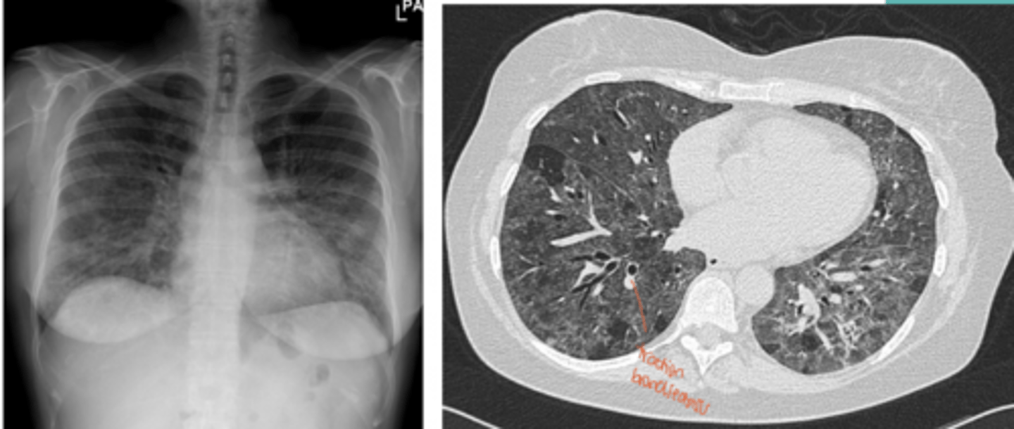<p>A 46-year-old man presents with progressively worsening shortness of breath and dry cough over the past 6 months. He also reports fatigue, intermittent low-grade fevers, chills, and unintentional weight loss. Symptoms seem worse after work and improve slightly on weekends.</p><p>He works on a farm handling moldy hay and grain.</p><p>Physical examination reveals:</p><p>Mild tachypnea</p><p>Fine inspiratory “squeaks” (crackles) at the lung bases</p><p>Early digital clubbing</p>