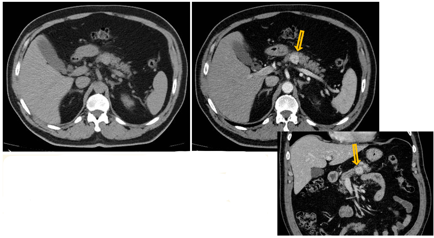 <p>Patient history: symptoms of hypoglycemia, sweating and weight gain in a 52-year-old patient</p><p>Modality: left – non-enhanced CT, axial plane; right – early arterial phase of dynamic CT (iv. iodinebased contrast agent), axial plane, and (bottom right) coronal reconstruction of the same study</p><p> Region: upper abdomen </p><p>Radiologic sign: solid mass in the pancreas body showing intensive early arterial contrast enhancement (yellow arrow) </p><p>Diagnosis: pancreas insulinoma</p>