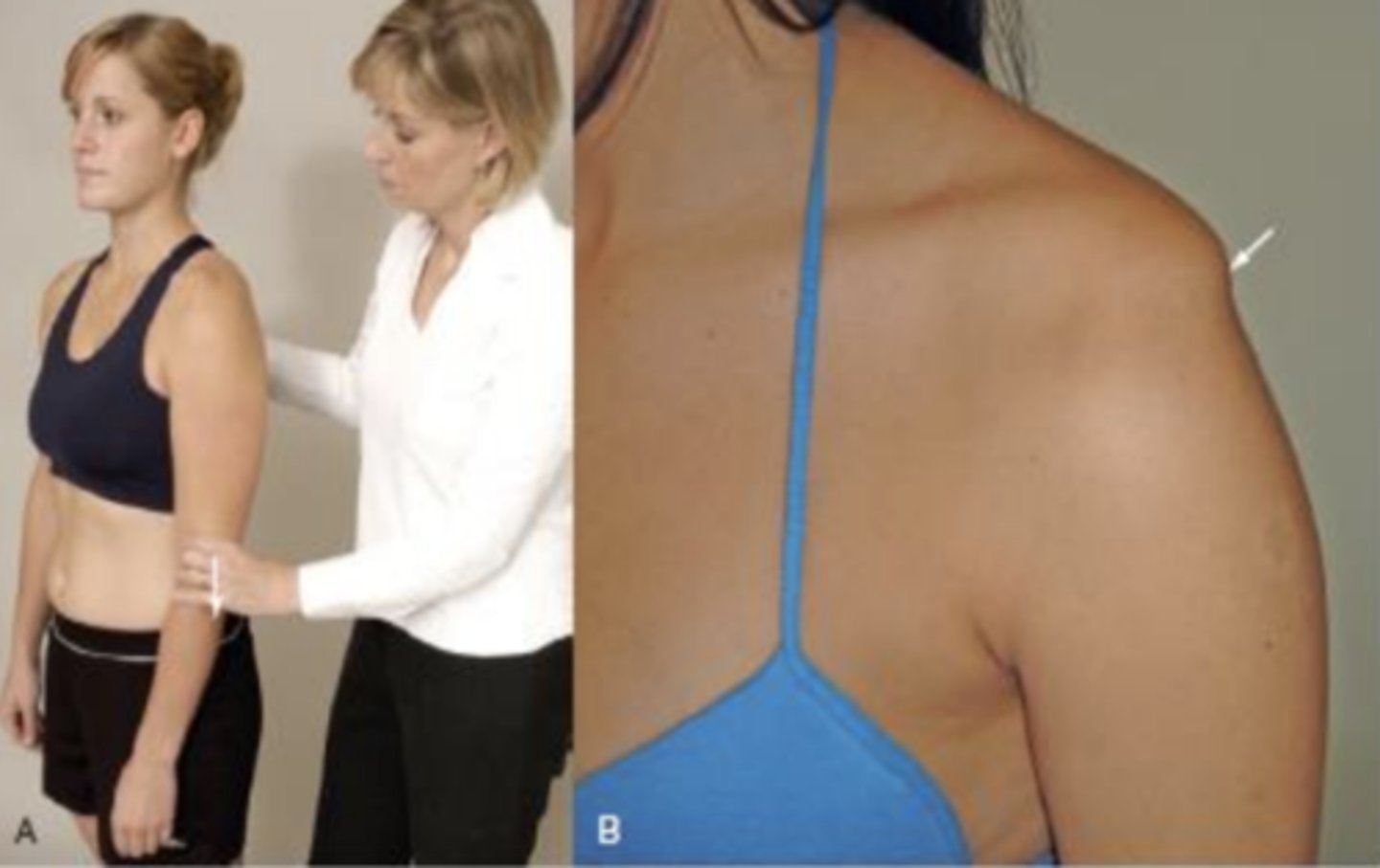 <p>- test for inferior glenohumeral instability</p><p>description: pt stands with the arm by the side and shoulder muscles relaxed. the PT grasps the pt's forearm below the elbow and pulls the arm distally.</p><p>(+): presence of sulcus sign indicates inferior instability of glenohumeral laxity</p>