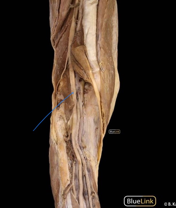 <p>The medial split of the sciatic nerve. It descends through the popliteal fossa and then in the posterior compartment of the leg,</p><p></p><p>innervates: semimembranosus, semitendinosus, hamstring part of adductor magnus, gastrocnemius, soleus, plantaris, flexor digitorum longus, flexor hallucis longus, tibialis posterior, popliteus</p>
