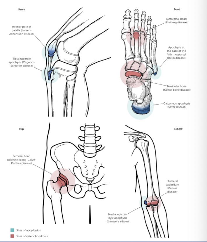 <p><strong>Part of a spectrum of Osteochondroses often seen during adolescence </strong></p><p><em>Causes: </em>Microtrauma: Repetitive use; Macrotrauma: Avulsion</p><p><em>Risk factors</em>: Rapid growth, general inflexibility, activities with rapid acceleration/deceleration</p><p><em>ie. Osgood-Schlatter Disease</em></p>