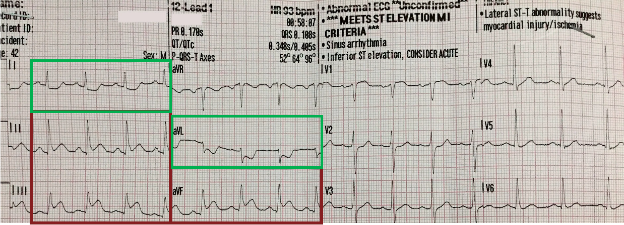 <p>1 mm or more of ST seg elevation in 2 or more contiguous leads w/ or w/o reciprocal changes</p>