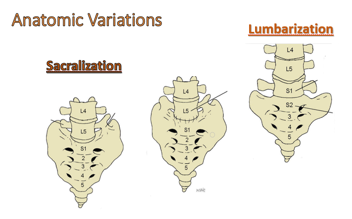 <p><span><strong><u>Sacralization</u>:</strong></span></p><p style="text-align: left"><span>deformity where one or both transverse processes of L5 articulate with the sacrum.</span></p><p style="text-align: left"><span>~3.5% of people have this, may lead to early disc degeneration.</span></p><p style="text-align: left"></p><p style="text-align: left"><span><strong><u>Lumbarization</u>:</strong> S1 failure to fuse with rest of sacrum. Less common than Sacralization.</span></p>