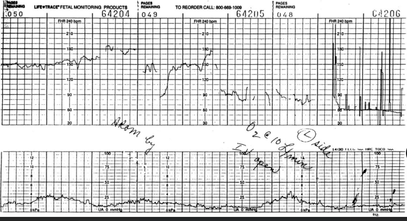 <p><strong>Vasa Previa</strong>: <strong>Diagnostics</strong></p><p>-Imaging</p><ul><li><p>Ultrasound → linear sonolucent area that passes over the _______ os </p></li><li><p>Color doppler flow and waveform analysis → umbilical artery or vein waveforms and confirms that the ___________ is a blood vessel</p></li></ul><p>-Physical Exam</p><ul><li><p>Usually ________</p></li><li><p>Rarely, pulsating vessels in the membranes overlying the cervical os are __________ on digital examination</p></li></ul><p>-Why it’s dangerous </p><ul><li><p>Spontaneous or iatrogenic ________ of the membranes → fetal bleeding → hypotension → fetal heart rate abnormalities → fetal ______ due to exsanguination </p></li><li><p>Pregnancies complicated by vasa previa and area also at increased risk for __________ birth</p></li></ul><p></p>