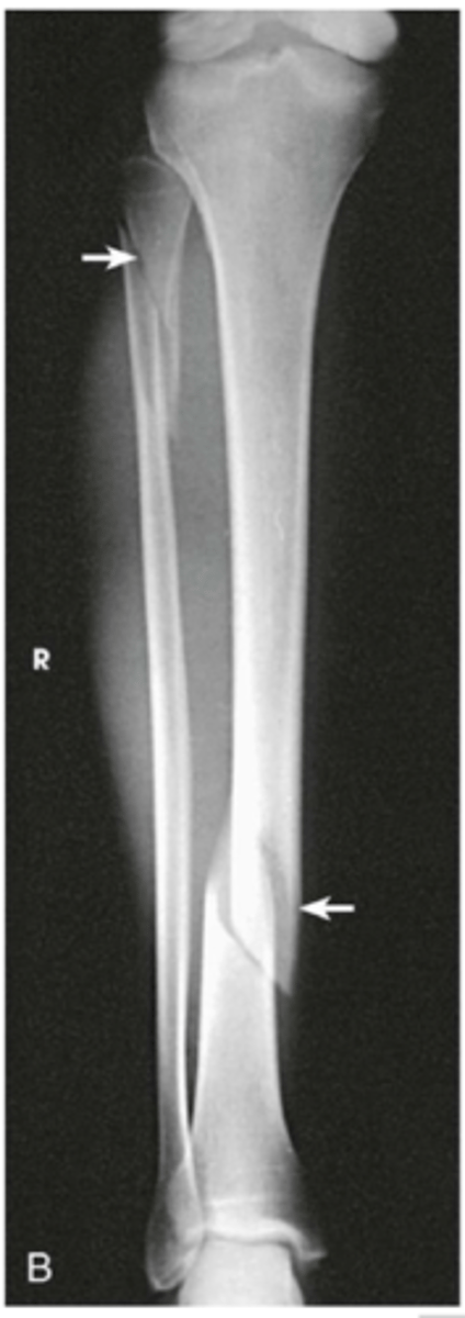 <p>1. Mechanism: direct force to fibula or indirect -- tibial torsion (skiing)<br>2. Symptoms: sudden pain and loss of function<br>3. Signs: a) possible deformity and crepitus, b) rapid swelling, c) delayed ecchymosis, d) possible false joint motion, e) painful weight bearing</p>