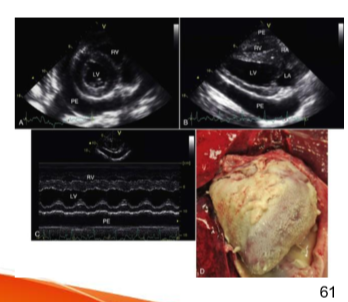 <p>Etiology: </p><ul><li><p>Idiopathic (most common) </p></li><li><p>secondary to septic events, dilated cardiomyopathy pleuropneumonia, pulmonary hypertension or congenital heart disease </p></li><li><p>hypoproteinemia (associated with mild effusion) </p></li></ul><p>Clinical signs: </p><ul><li><p>lethargy</p></li><li><p>tachycardia </p></li><li><p>muffled heart sounds </p></li><li><p>tachypnea </p></li><li><p>cardiac tamponade (in severe cases) </p></li></ul><p>treatment: </p><ul><li><p>pericardiocentesis </p></li><li><p>systemic antibiotics and anti-inflammatory drugs </p></li><li><p>supportive care (IV fluids) </p></li></ul><p>prognosis </p><ul><li><p>favorable with prompt intervention </p></li><li><p>idiopathic cases may resolve without recurrence </p></li><li><p>secondary cases depend on underlying disease </p></li></ul><p></p>