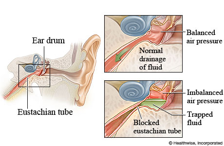 <p><strong>middle ear (Eustachian tube) </strong>is in the tx area</p>