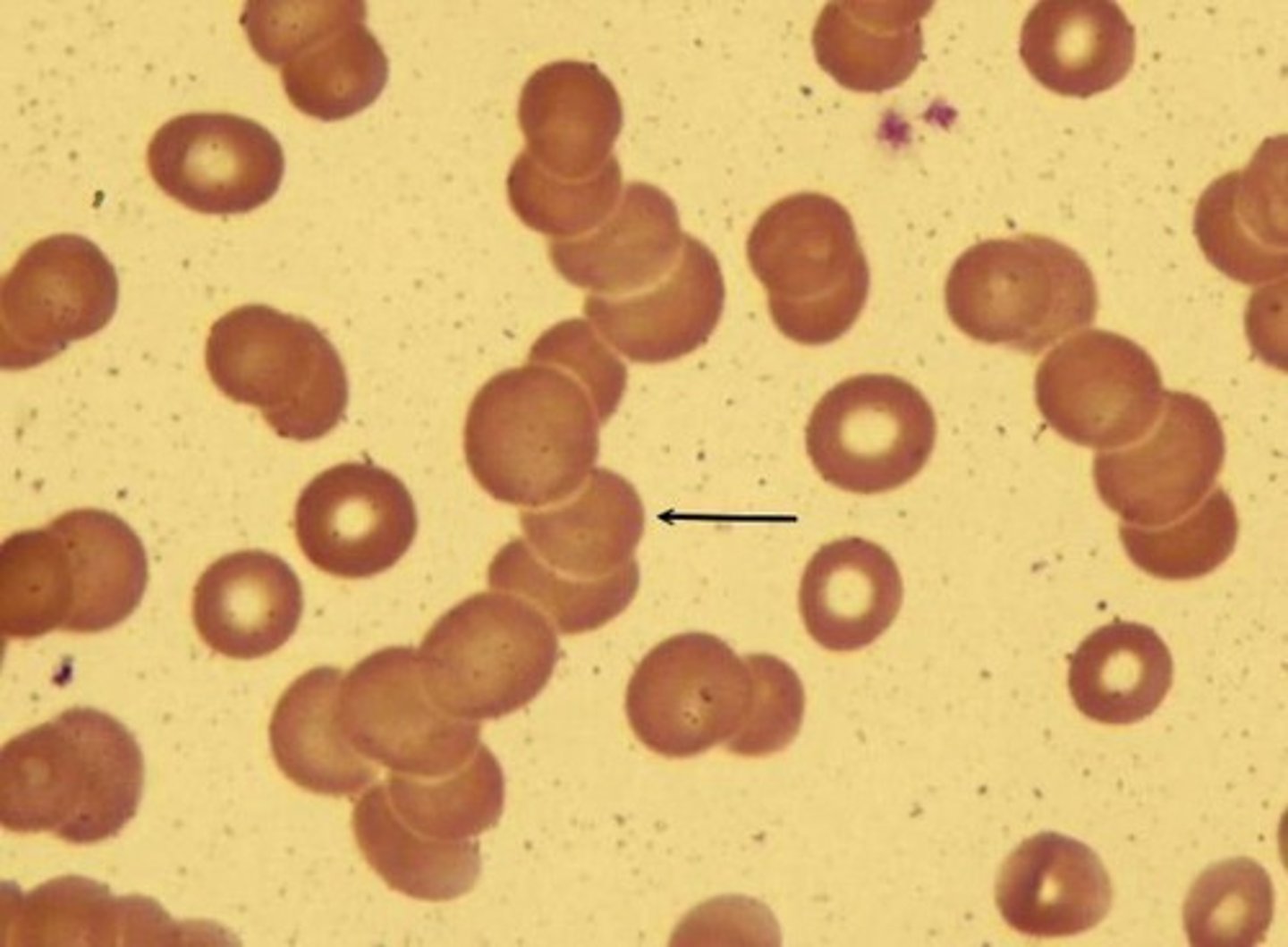 <p>aggregation of RBC's - Rouleaux formation</p>