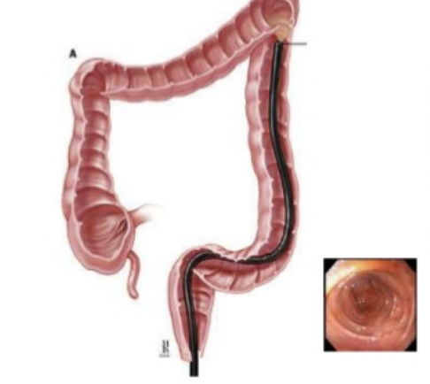 <p>visualize part of the colon using less sedation and cleanout prep</p>