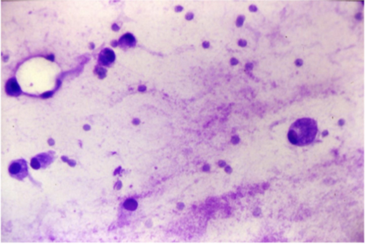 <p>What type of neoplastic tumor is this?</p>