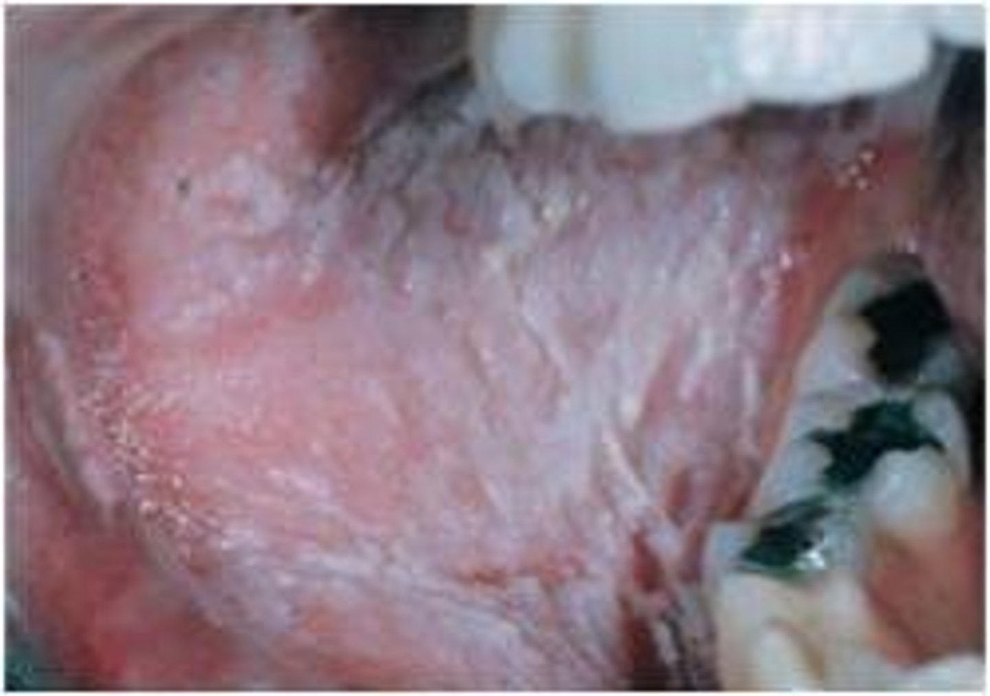 <p>1. White, corrugated, soft, folding buccal oral mucosa</p><p>2. Thick layer of keratin that desquamates and leaves a raw mucosal surface</p><p>3. Free gingiva is not affected</p>