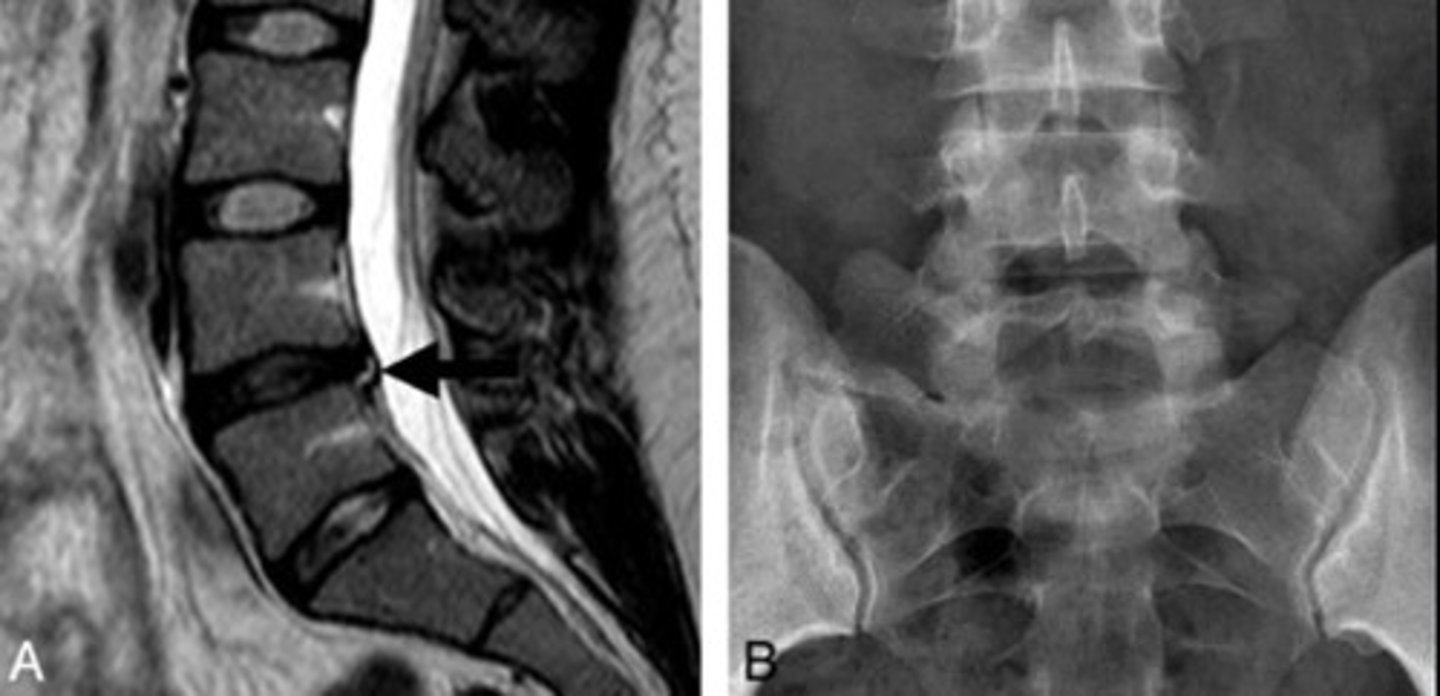 <p>Disc herniation with sacralization</p>