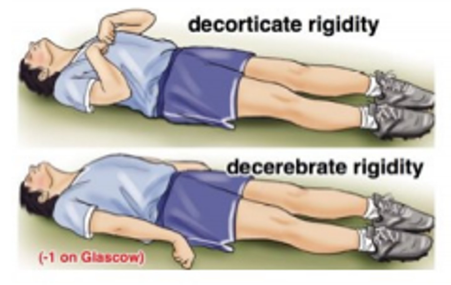 <p>decorticate → flexion of lower arms</p><p>decerebrate → extension of lower arms → poor prognosis</p>