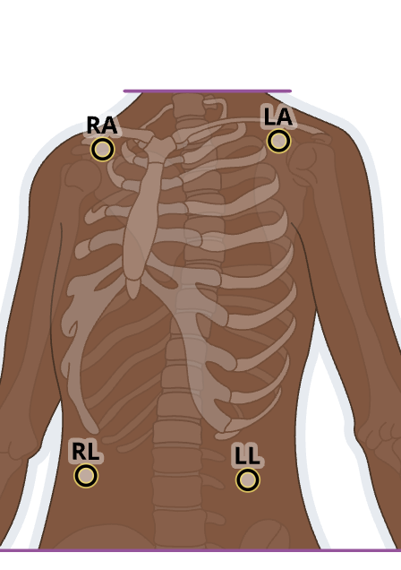 <p>white: right shoulder</p><p>black: left shoulder</p><p>red: left lower abdominal</p><p>green: right lower abdominal</p>