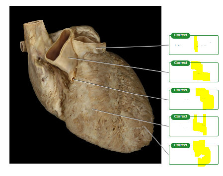 <p>Label the features of the heart&nbsp;seen on the external surface.</p><p><span style="font-size: inherit; font-family: inherit"><br></span></p>