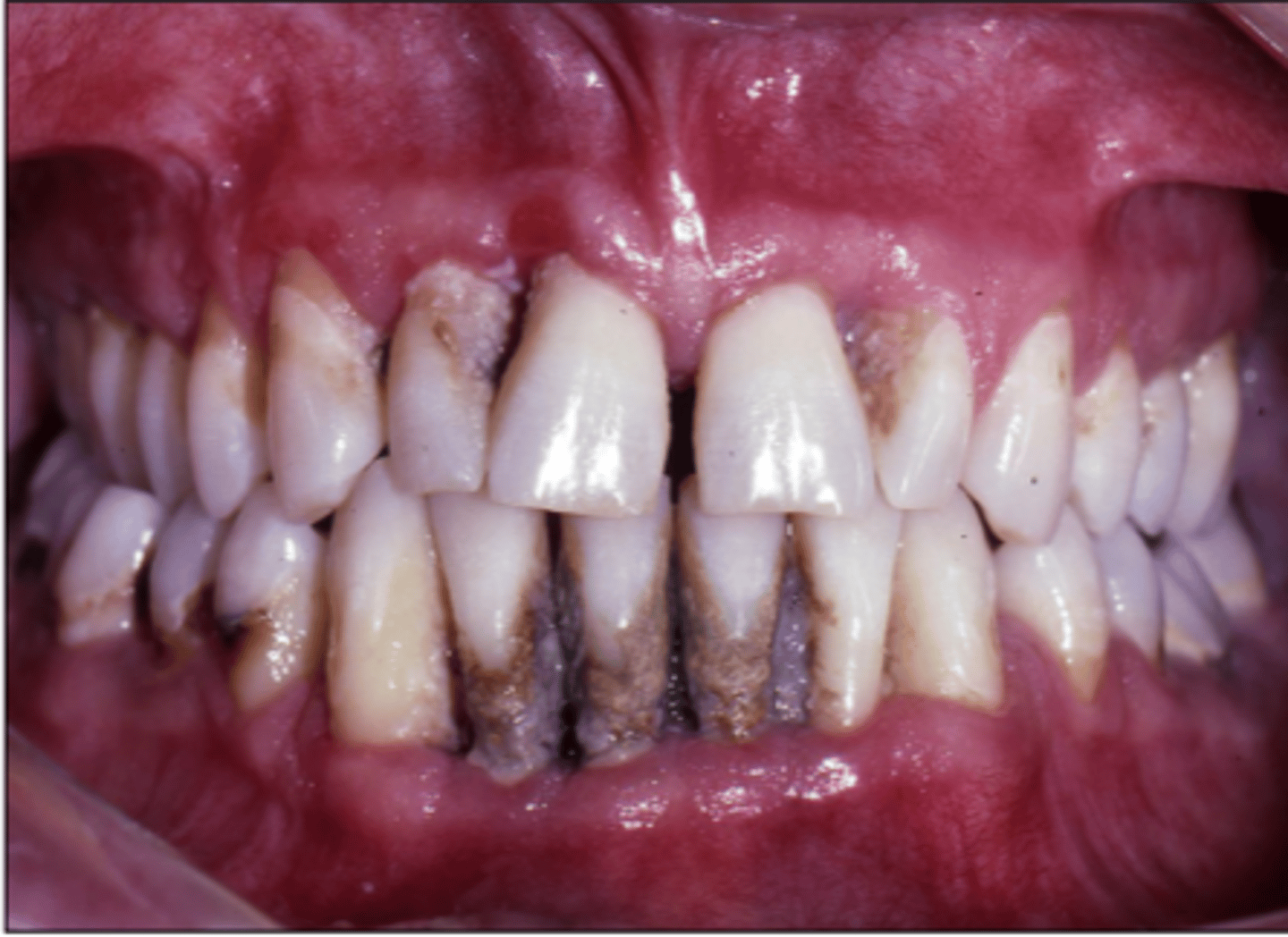 <p>true</p><p>may present with relatively few local factors &amp; destroys attachment apparatus</p>