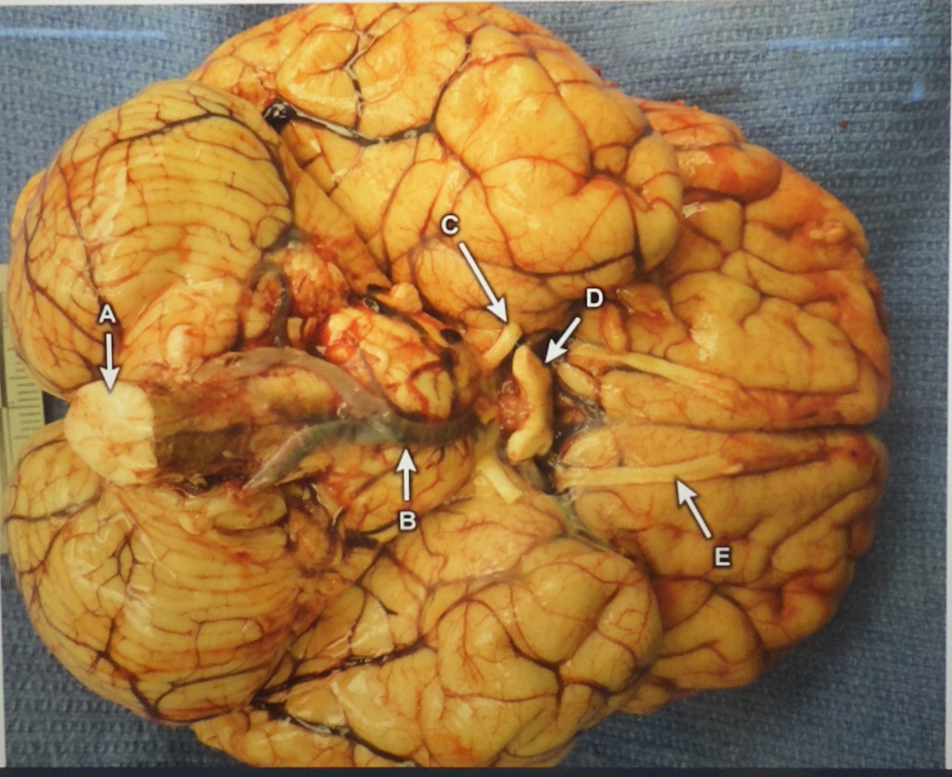 <p><span style="color: rgb(0, 0, 0)">A 24-year-old man presents with seizures after 2 days of fever, headache, vomiting, and meningeal signs. He rapidly deteriorates and dies within 48 hours despite treatment. Autopsy shows congested leptomeninges with fibrinopurulent exudate, and microscopy reveals numerous amoebae in the brain tissue.</span><br><strong>Question:</strong><span style="color: rgb(0, 0, 0)">&nbsp;What is the most likely portal of entry for this pathogen into the CNS?&nbsp;</span></p><img src="blob:null/5269fdbb-d3ff-428b-935f-249d0d35576d">