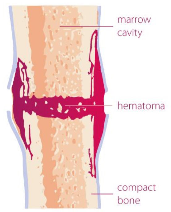 <p>blood vessels in the broken bone tear and hemorrhage, resulting in the formation of clotted blood, or a hematoma, at the site of the break</p><p>the severed blood vessels at the broken ends of the bone are sealed by the clotting process</p><p>bone cells deprived of nutrients begin to die</p><p>0-2 weeks</p>