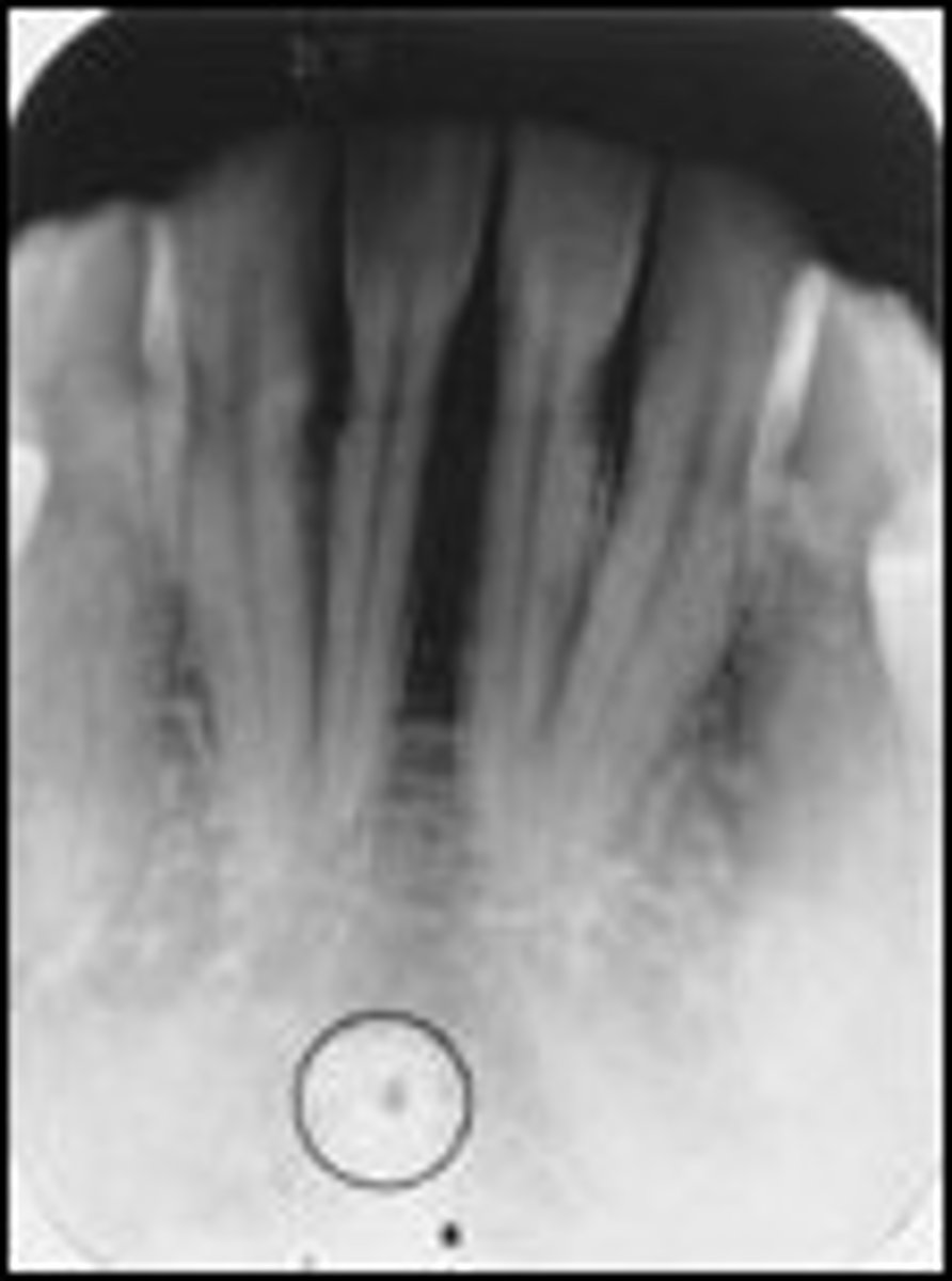 <p>Radiopaque ring below mandibular incisors</p>