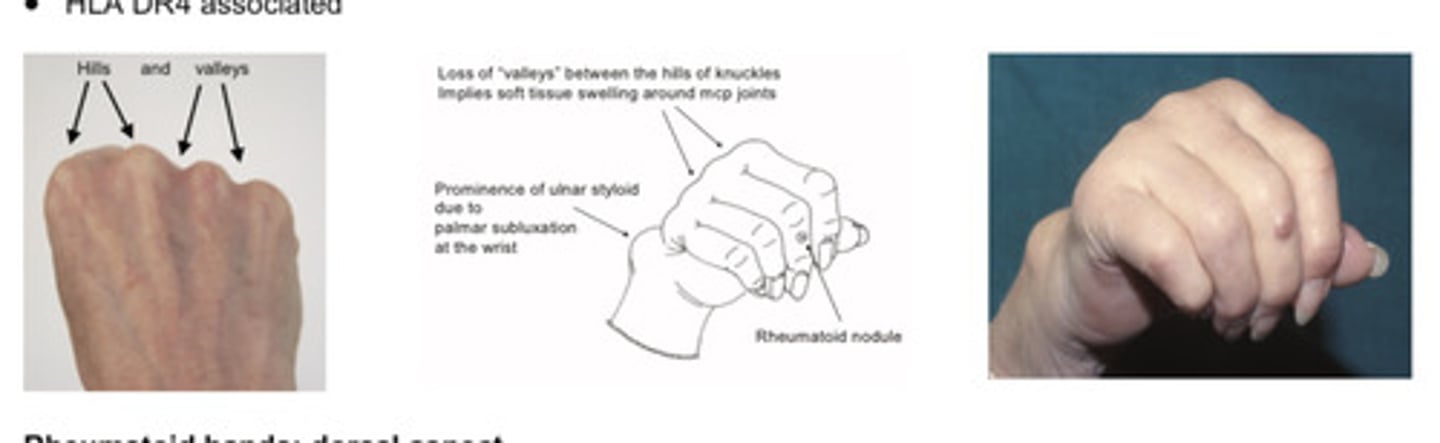 <p>Symmetrical, inflammatory arthritis</p><p>Small joints of hands and feet</p><p>Also hips, elbows and knees</p><p>Young adults, F>M</p><p>HLA DR4 associate</p>
