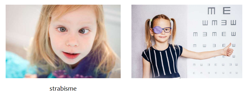 <p>= verminderde gezichtsscherpte in 1 oog door abnormale vroege visuele ervaring (lui oog) &amp; gebrek aan binoculaire dieptewaarneming (stereopsis)</p><ul><li><p>oorzaken:</p><ul><li><p>strabisme (= scheelzien)</p><ul><li><p>1 oog zo gedraaid dat het de wereld vanuit abnormale hoek bekijkt</p></li></ul></li><li><p>anisometropie</p><ul><li><p>2 ogen hebben zeer verschillende refractieafwijkingen (bv. ene oog is verziend &amp; andere niet)</p></li></ul></li></ul></li></ul><p>→ klinische behandeling: plakken van pleister over goede oog &amp; dwingen van amblyope oog om te werken</p><ul><li><p>deze behandeling enkel uitgevoerd bij jonge kinderen (meestal jonger dan 8 jaar)</p></li></ul><p></p>