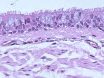 <p>Which one: <strong>Basal Cell Carcinoma</strong> OR <strong>Normal Epithelium</strong></p>