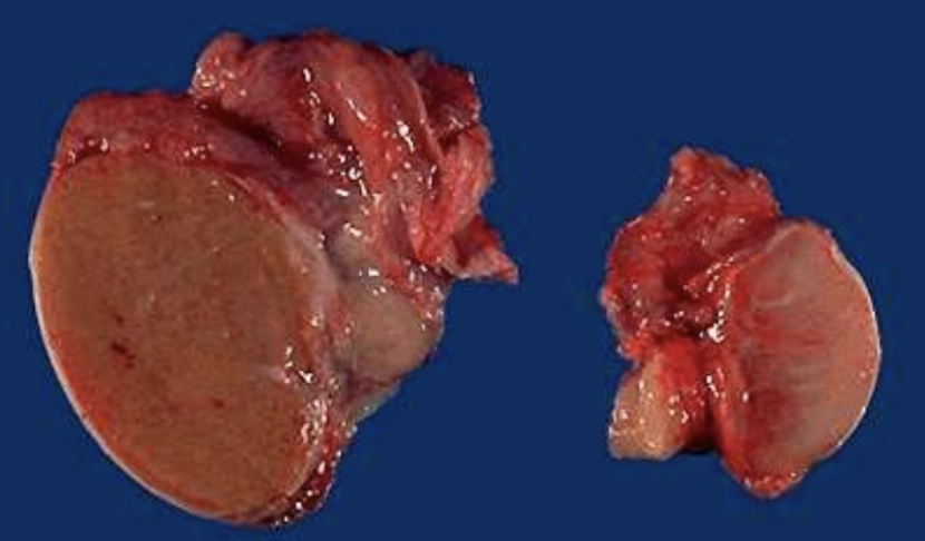 <p>Shrinkage caused by disease or altered environment (e.g., ischemic kidney, testicular atrophy, <strong>Alzheimer brain</strong>).</p>