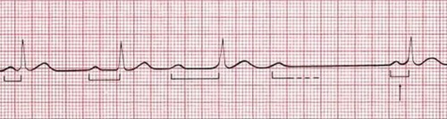 <p>Not every atrial impulse is able to pass through the AV node into the ventricles</p><p>extra P wave, where there is no QRS</p><p>PR interval = progressively lengthening, until a P wave (atrial conduction) is blocked from entering the ventricles (not conducted)</p><p>ventricular rate &lt; atrial rate</p>