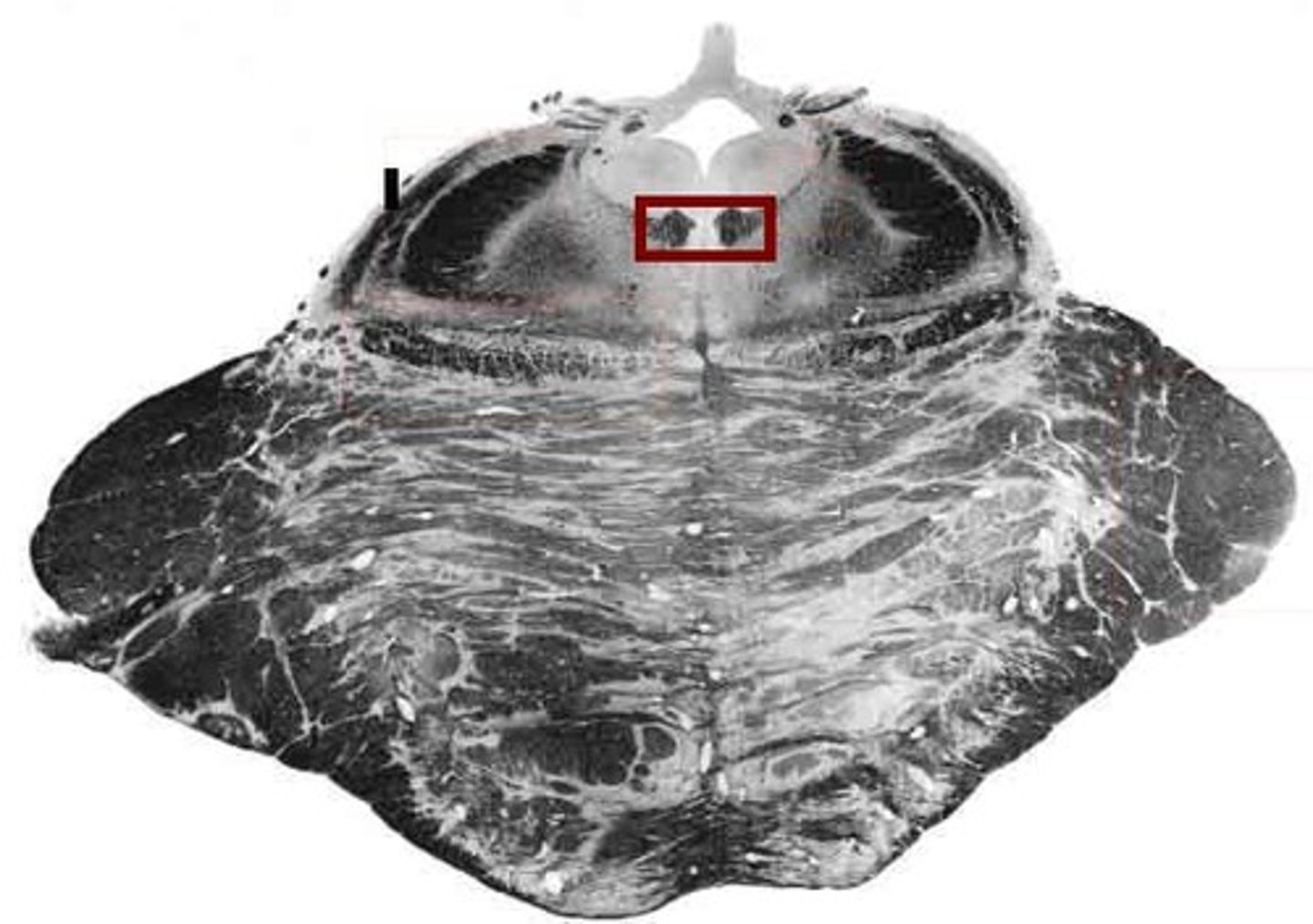 <p>Internuclear opthalmoplegia</p><p>(damage to MLF; may be unilateral or bilateral)</p>