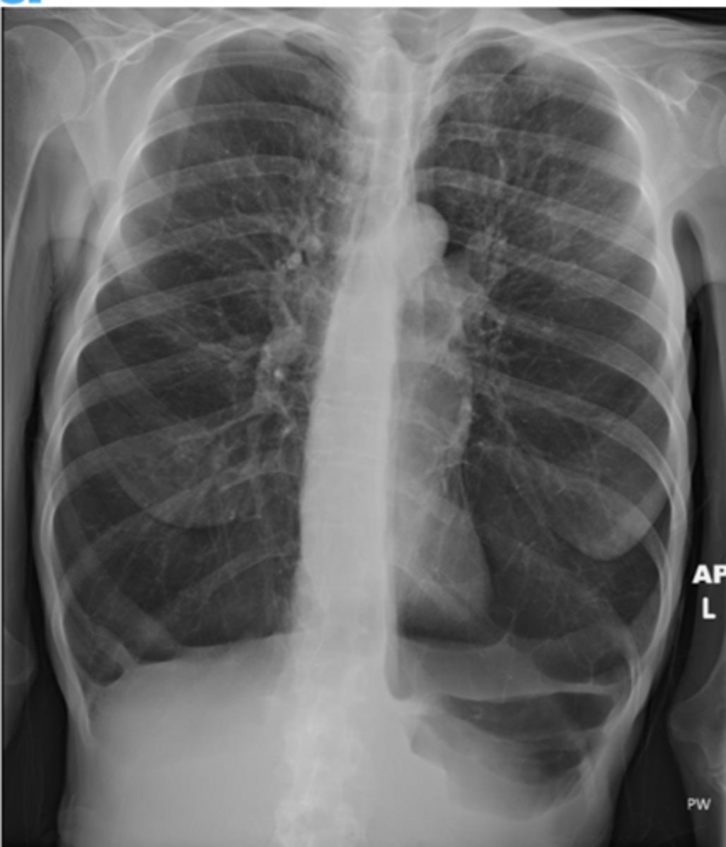 <p>Patient presents with tachypnea, absence of cyanosis, pursed-lip breathing, tripod position, barrel chest</p><p>Exam:</p><p>reduced breath sounds, hyper-resonant to percussion</p>