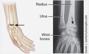 <p>Fracture of the distal end of the lateral forearm bone (radius) in which the distal fragment is displaced posteriorly.</p>