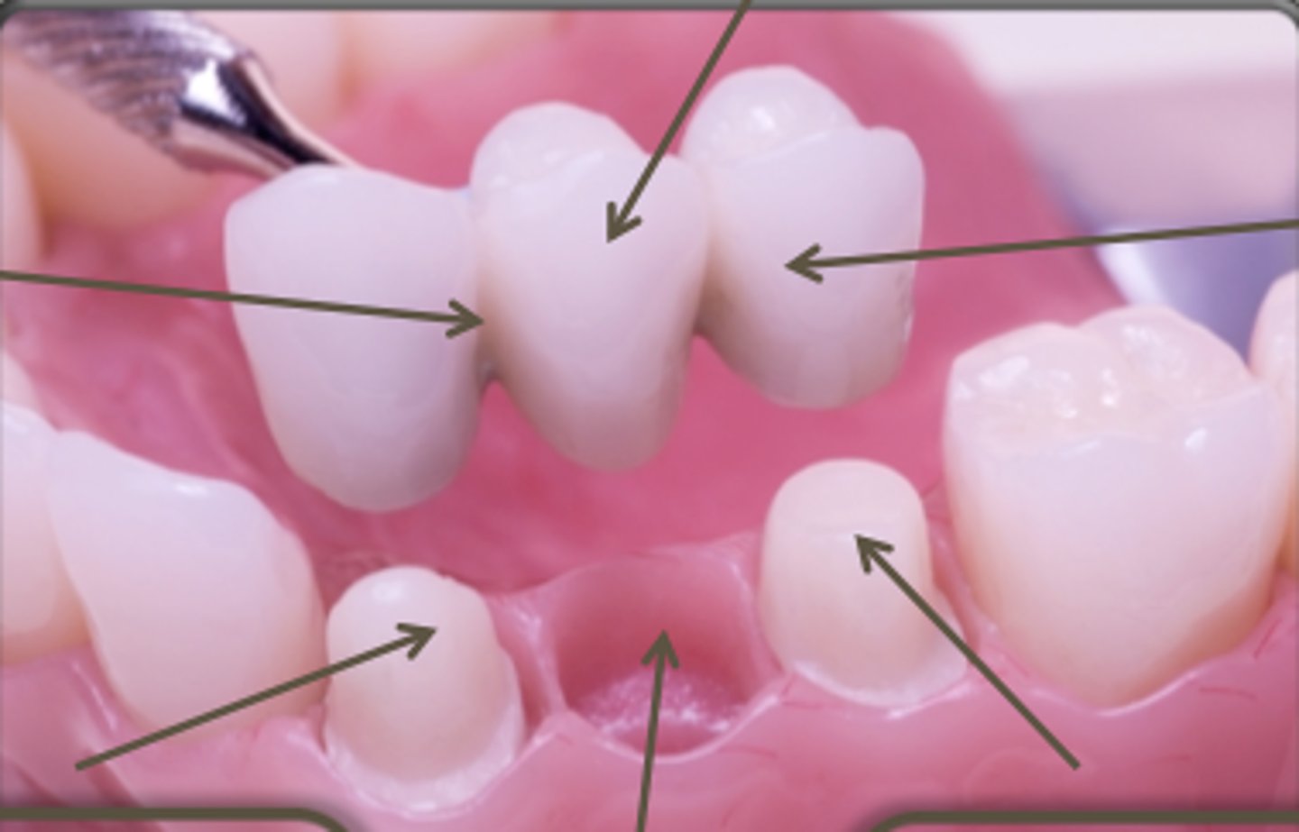 <p>fixed prosthesis replacing a missing tooth/teeth.</p>
