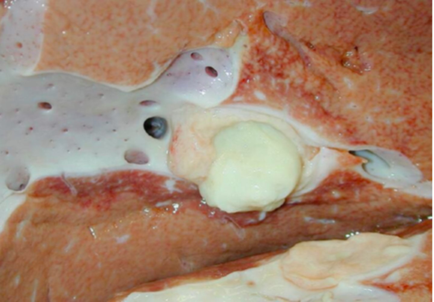 <p>Lever fra kvæg m. v. heptatica, hvad er den patoanatomiske diagnose?</p>