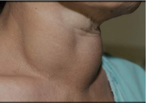 <p><span>Which condition does this patient have?</span></p><p></p>