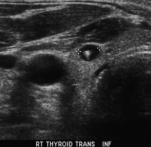 what thyroid pathology is shown here?
